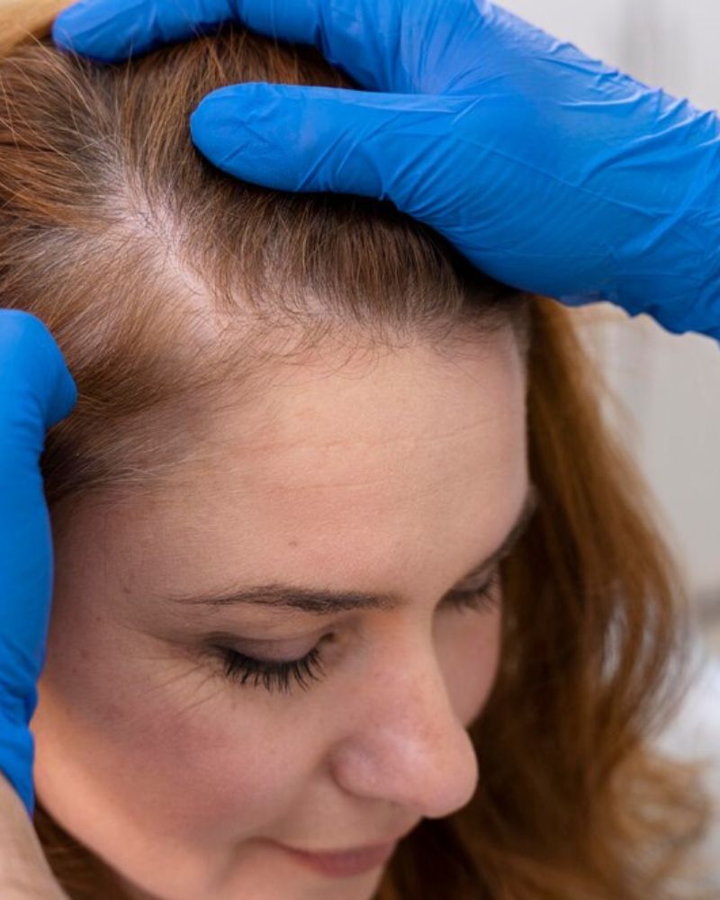 Female Pattern Hair Loss Treatment