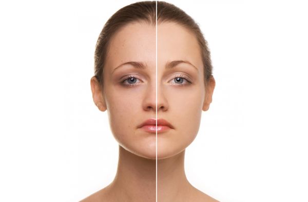 HIFU Treatment before and after