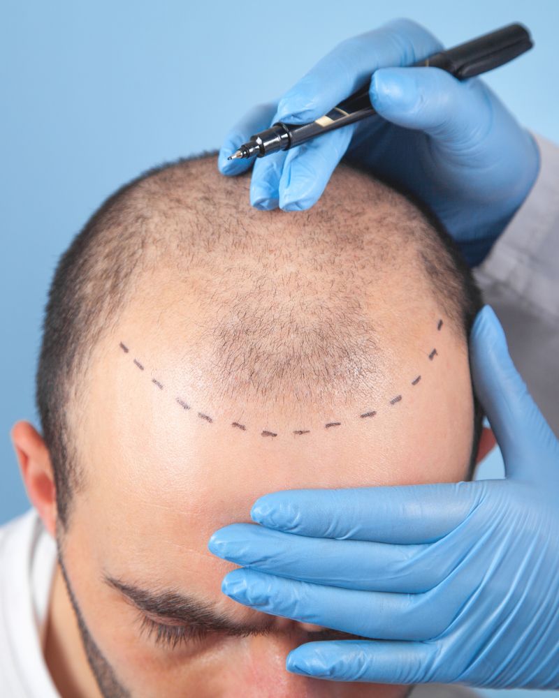 Hair Transplant Treatment