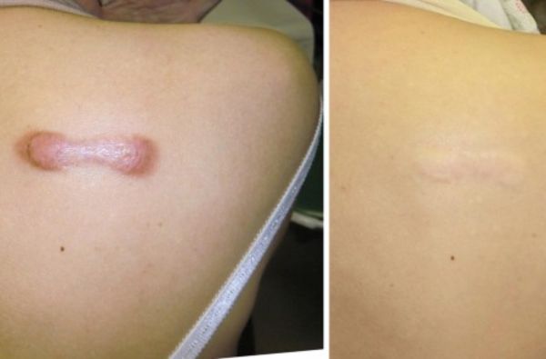 Keloid, Hypertrophic Scar Treatment before and after
