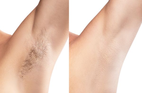 Laser Hair Reduction before and after
