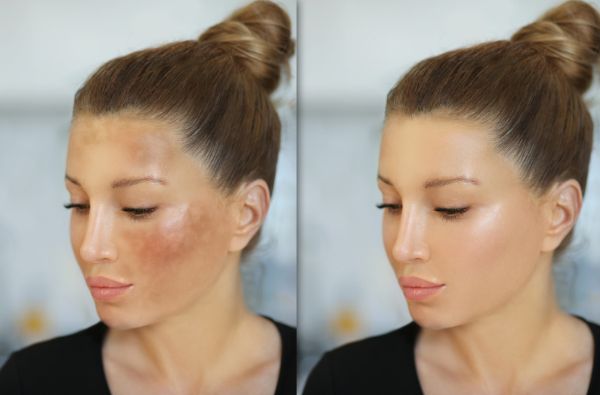 Melasma Treatment before and after