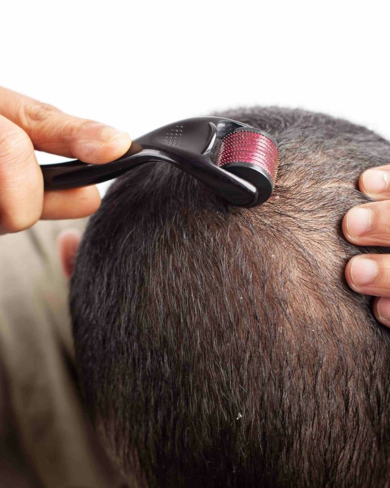 Mesotherapy For Hair Treatment