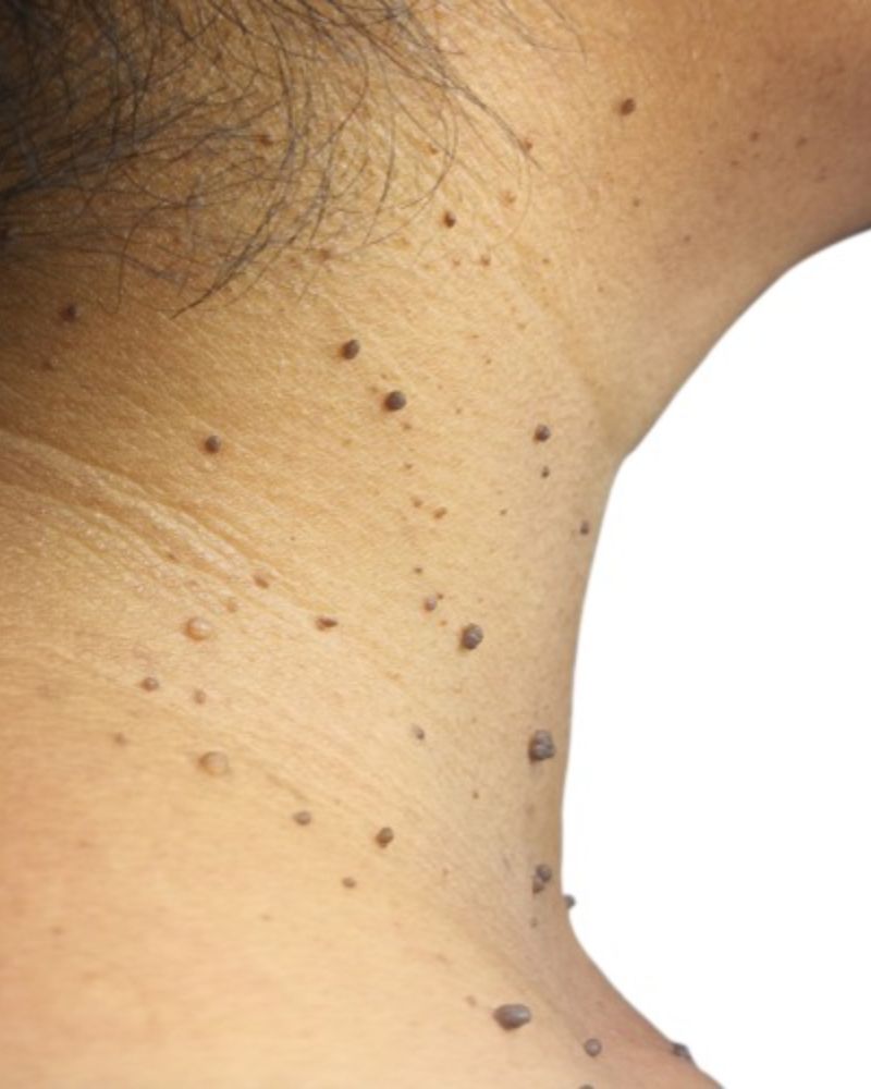 Mole, Skin Tag Removal