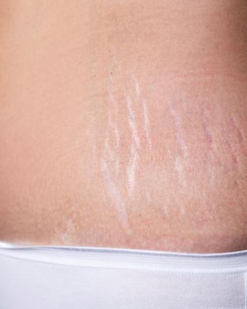 Stretch Marks Reduction