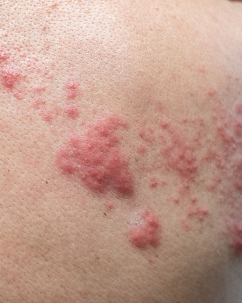 Urticaria Treatment
