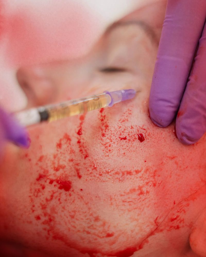 Vampire Facial Treatment