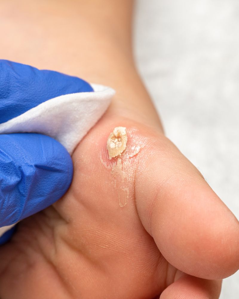 Wart Treatment