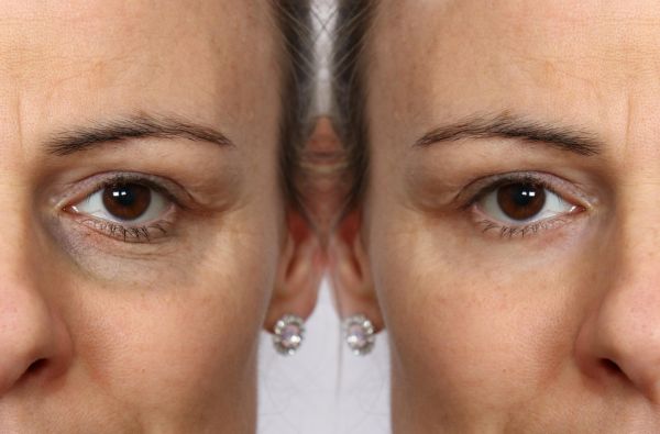 CO2 Laser before and after treatment