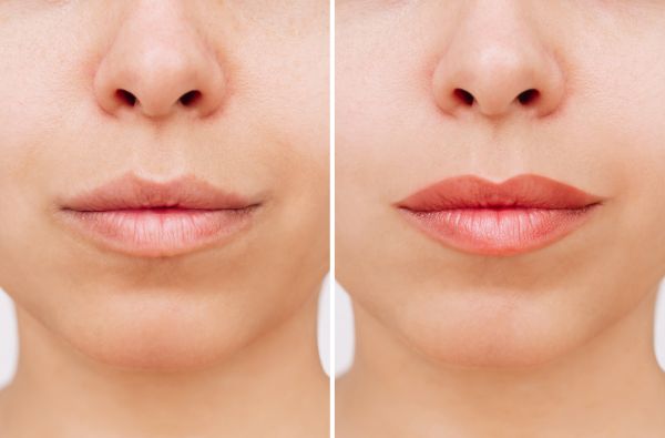 Dermal Fillers before and after