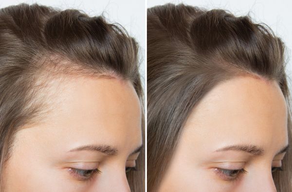 Female Pattern Hair Loss Treatment before and after