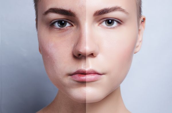 HydraFacial Treatment before and after
