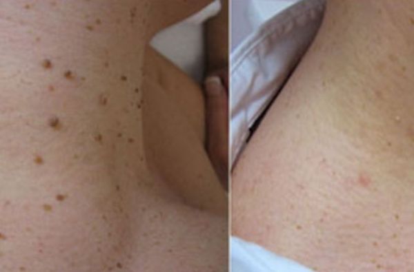 Mole, Skin Tag Removal before and after