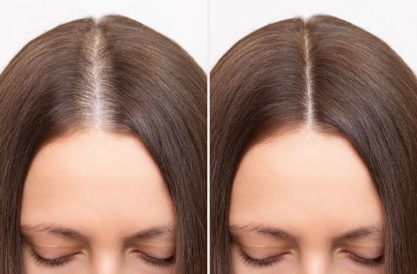 PRP Treatment before and after