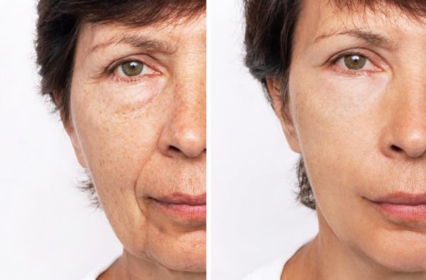 Skin Boosters before and after treatment