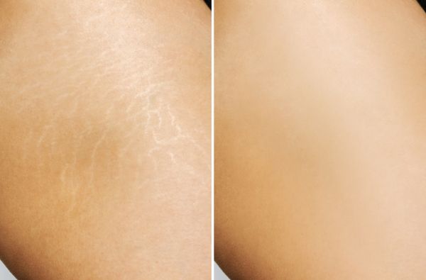 Stretch Marks Reduction before and after