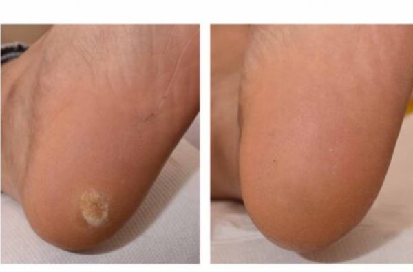 Wart Treatment before and after